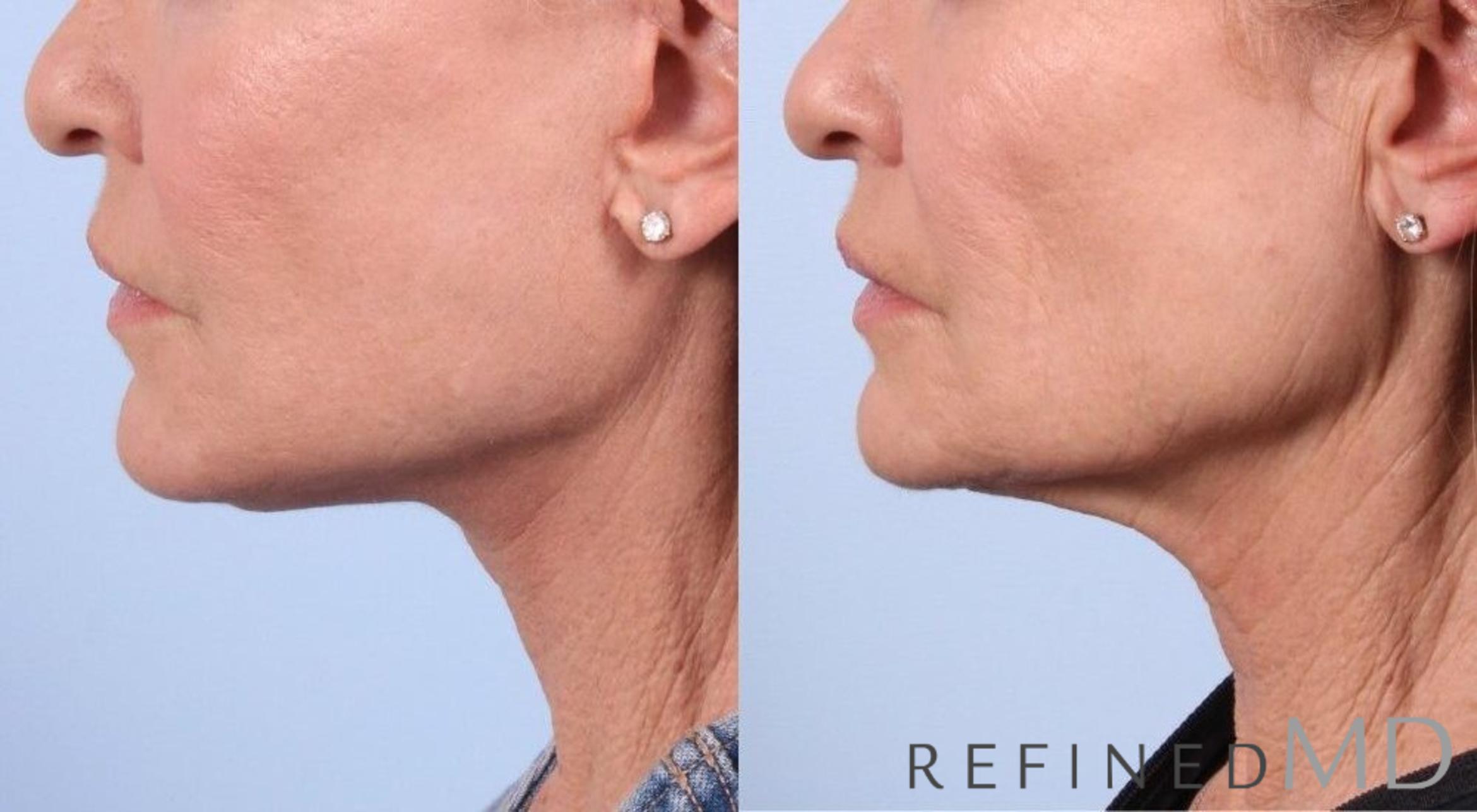 Before & After Facelift Case 1054 View 3 View in Los Gatos & San Jose, CA