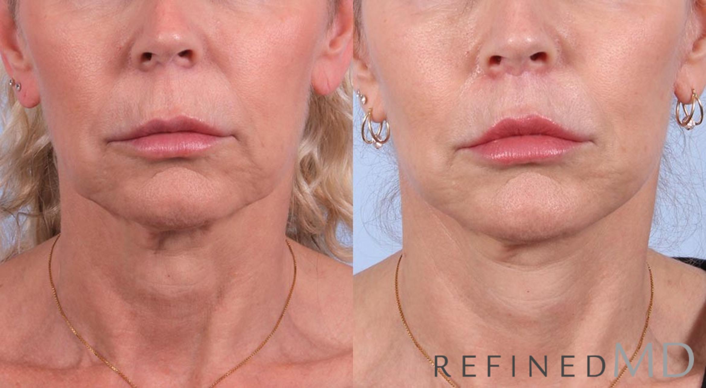 Before & After Facelift Case 1055 View 1 View in Los Gatos & San Jose, CA
