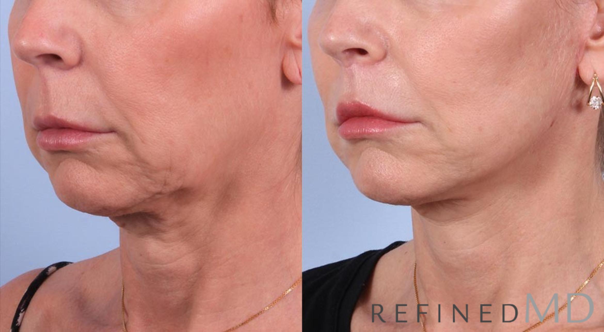 Before & After Facelift Case 1055 View 2 View in Los Gatos & San Jose, CA
