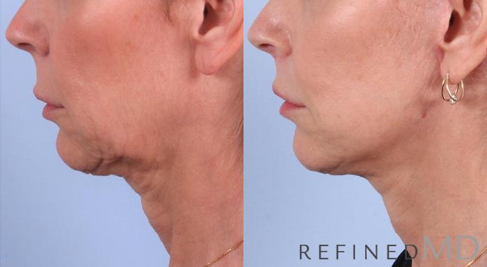 Before & After Facelift Case 1055 View 3 View in Los Gatos & San Jose, CA