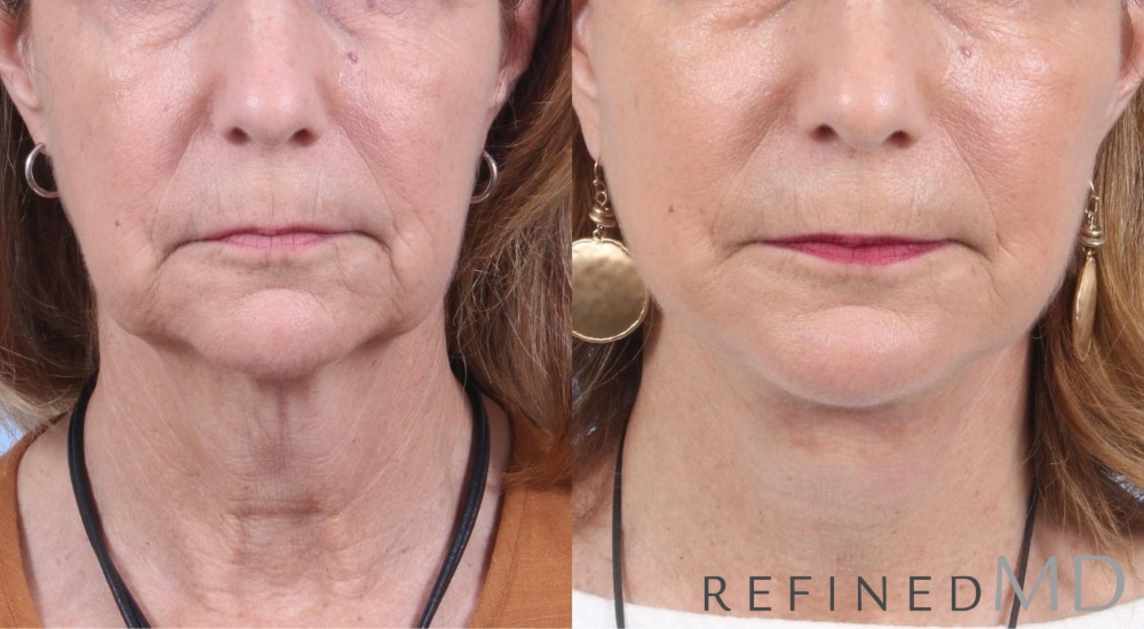 Before & After Facelift Case 1056 View 1 View in Los Gatos & San Jose, CA