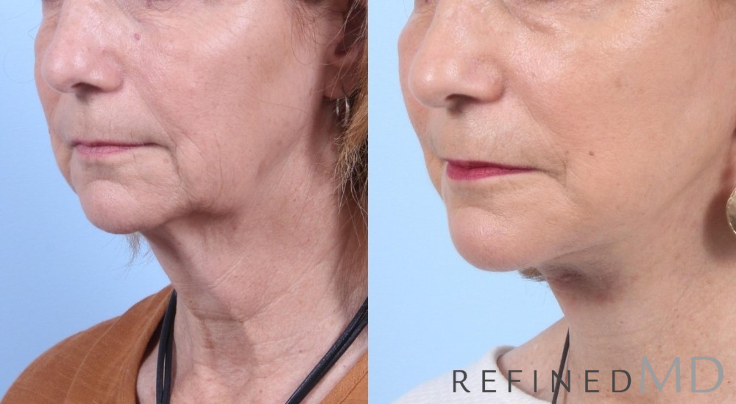 Before & After Facelift Case 1056 View 2 View in Los Gatos & San Jose, CA