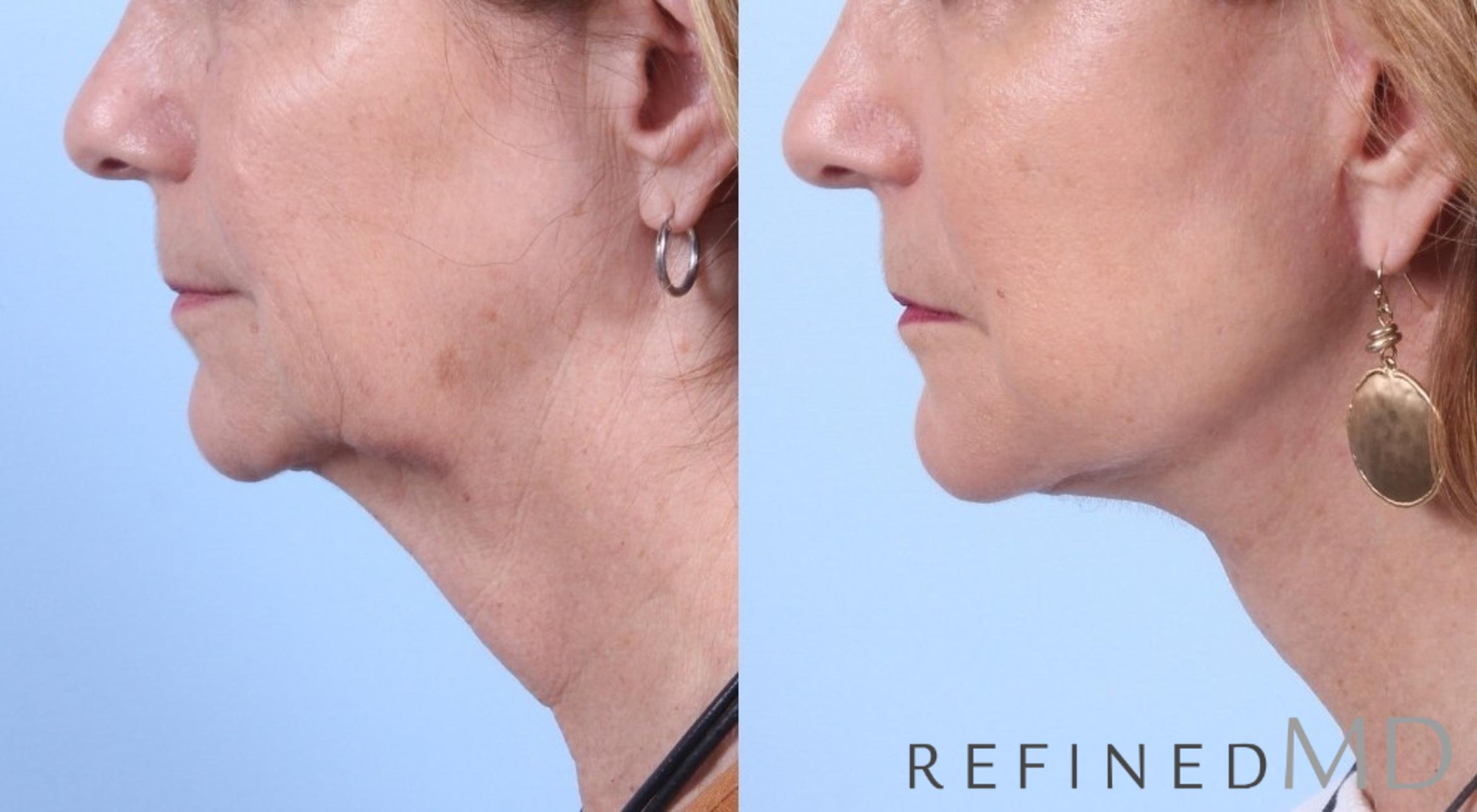 Before & After Facelift Case 1056 View 3 View in Los Gatos & San Jose, CA