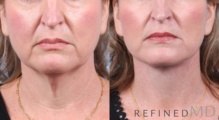 Before & After Facelift Case 1057 View 1 View in Los Gatos & San Jose, CA