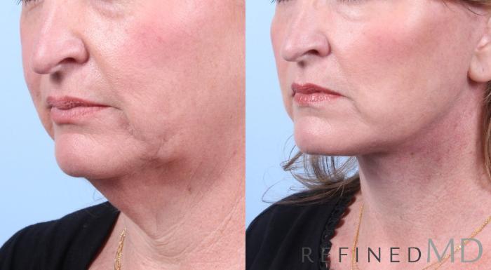 Before & After Facelift Case 1057 View 2 View in Los Gatos & San Jose, CA