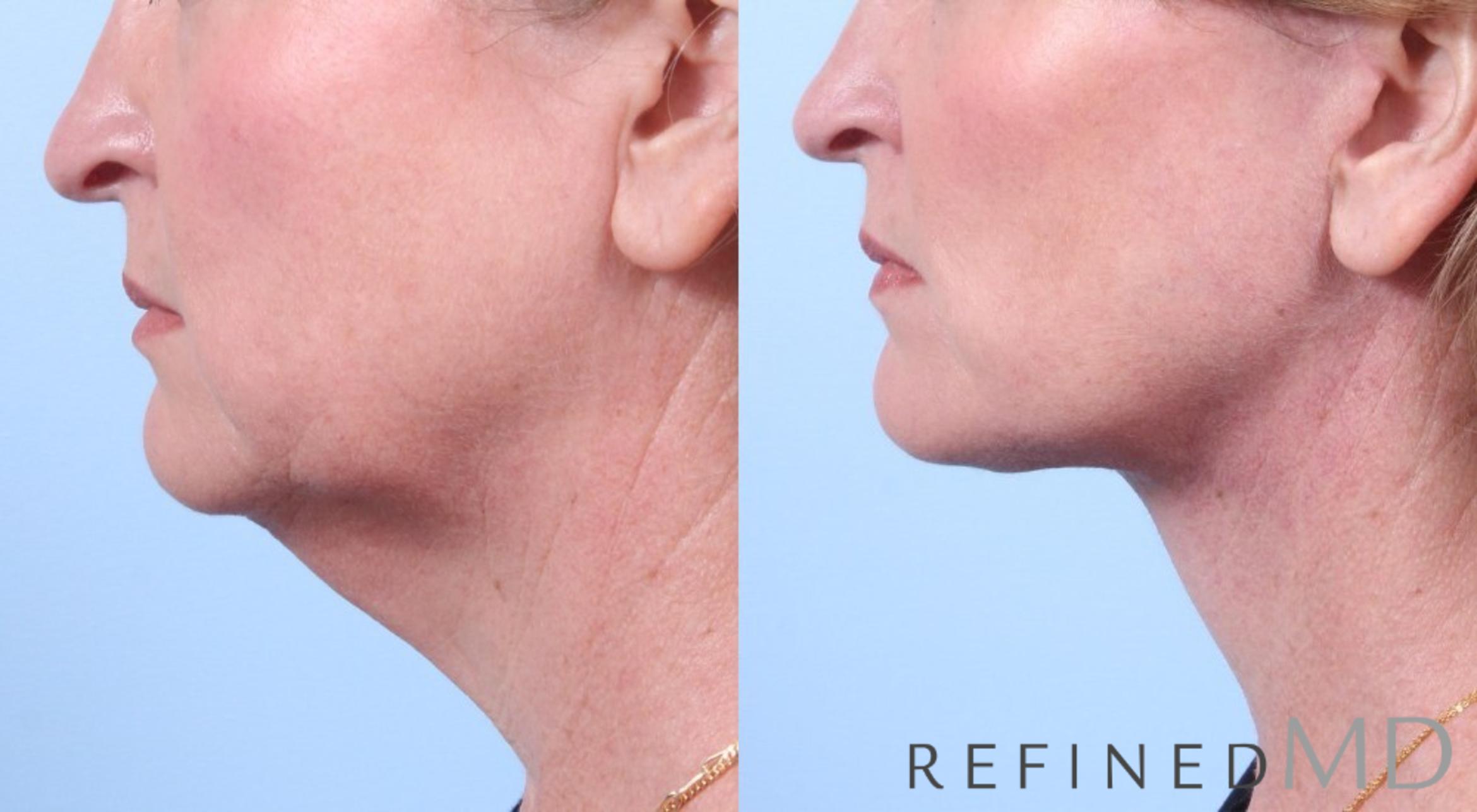 Before & After Facelift Case 1057 View 3 View in Los Gatos & San Jose, CA