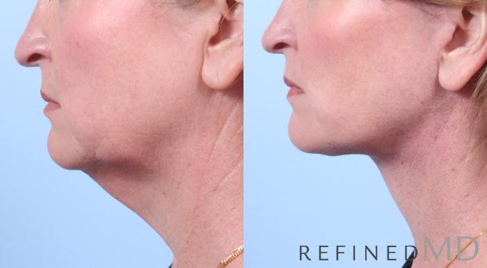 Before & After Facelift Case 1057 View 3 View in Los Gatos & San Jose, CA