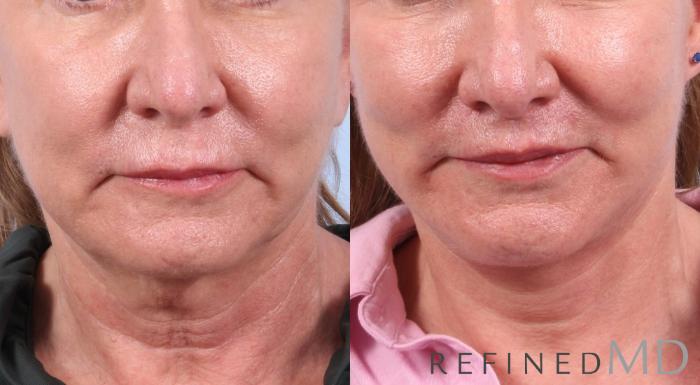 Before & After Facelift Case 1058 View 1 View in Los Gatos & San Jose, CA
