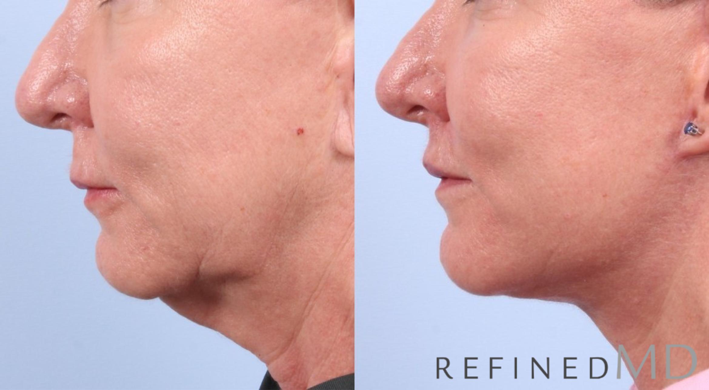 Before & After Facelift Case 1058 View 2 View in Los Gatos & San Jose, CA