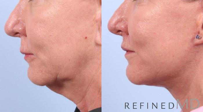 Before & After Facelift Case 1058 View 2 View in Los Gatos & San Jose, CA