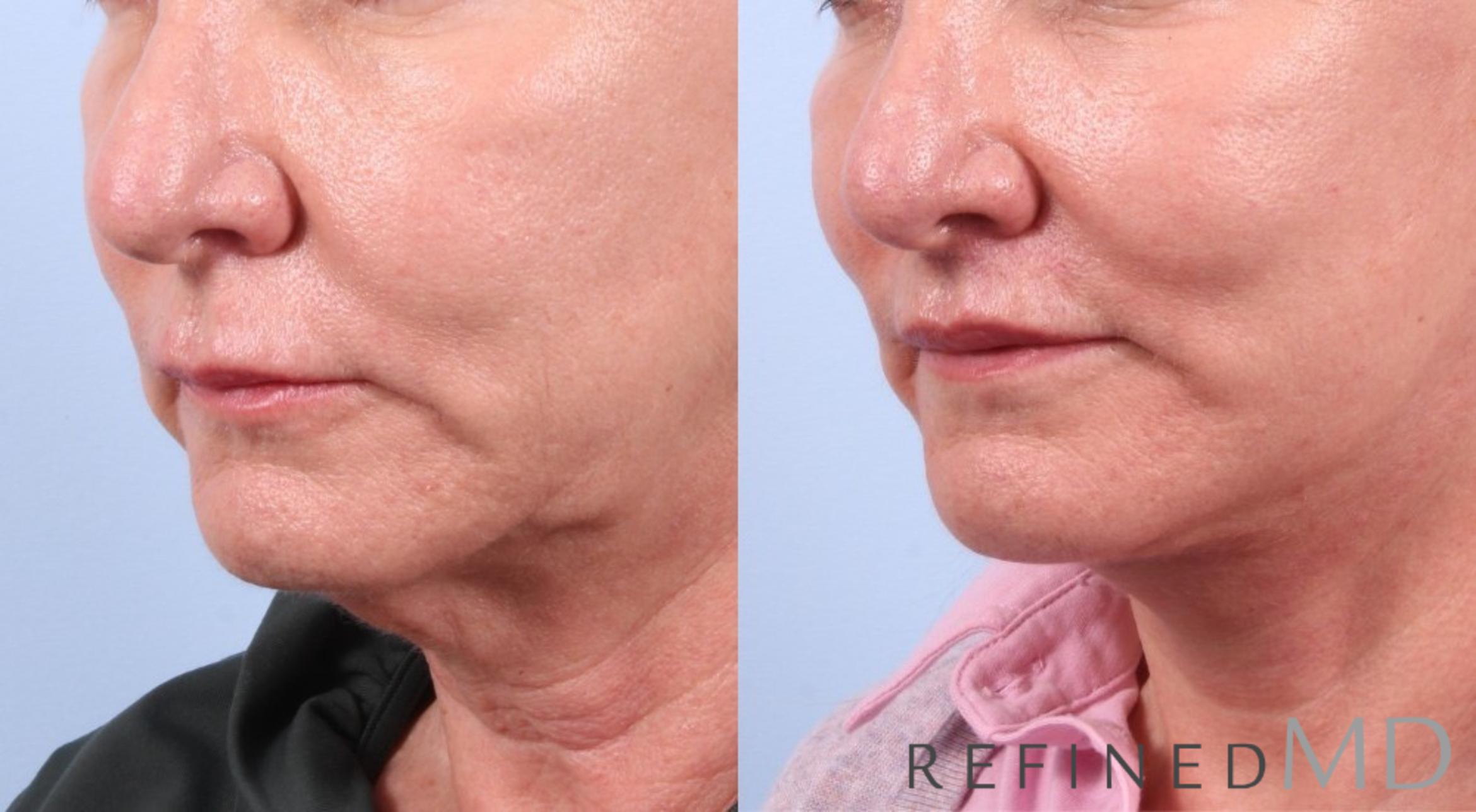 Before & After Facelift Case 1058 View 3 View in Los Gatos & San Jose, CA