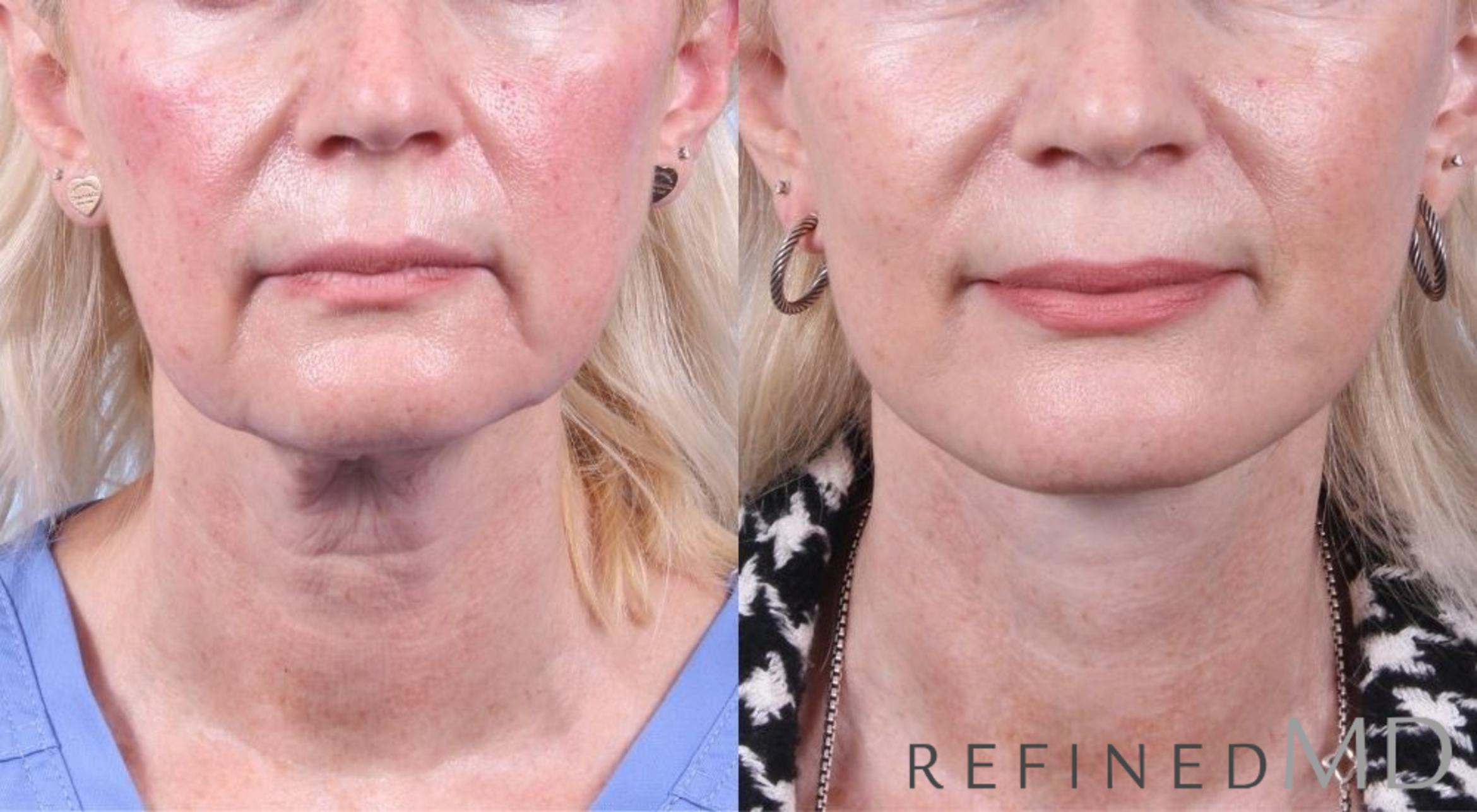Before & After Facelift Case 1059 View 1 View in Los Gatos & San Jose, CA