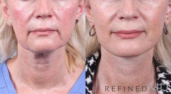 Before & After Facelift Case 1059 View 1 View in Los Gatos & San Jose, CA