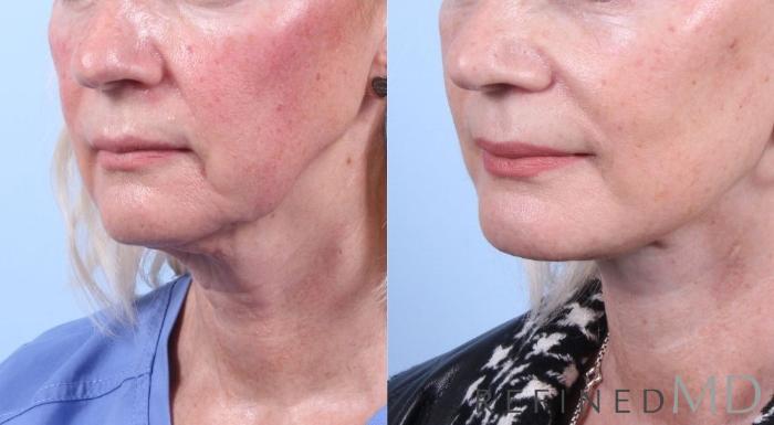 Before & After Facelift Case 1059 View 2 View in Los Gatos & San Jose, CA