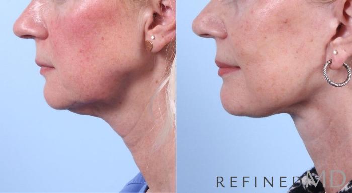 Before & After Facelift Case 1059 View 3 View in Los Gatos & San Jose, CA