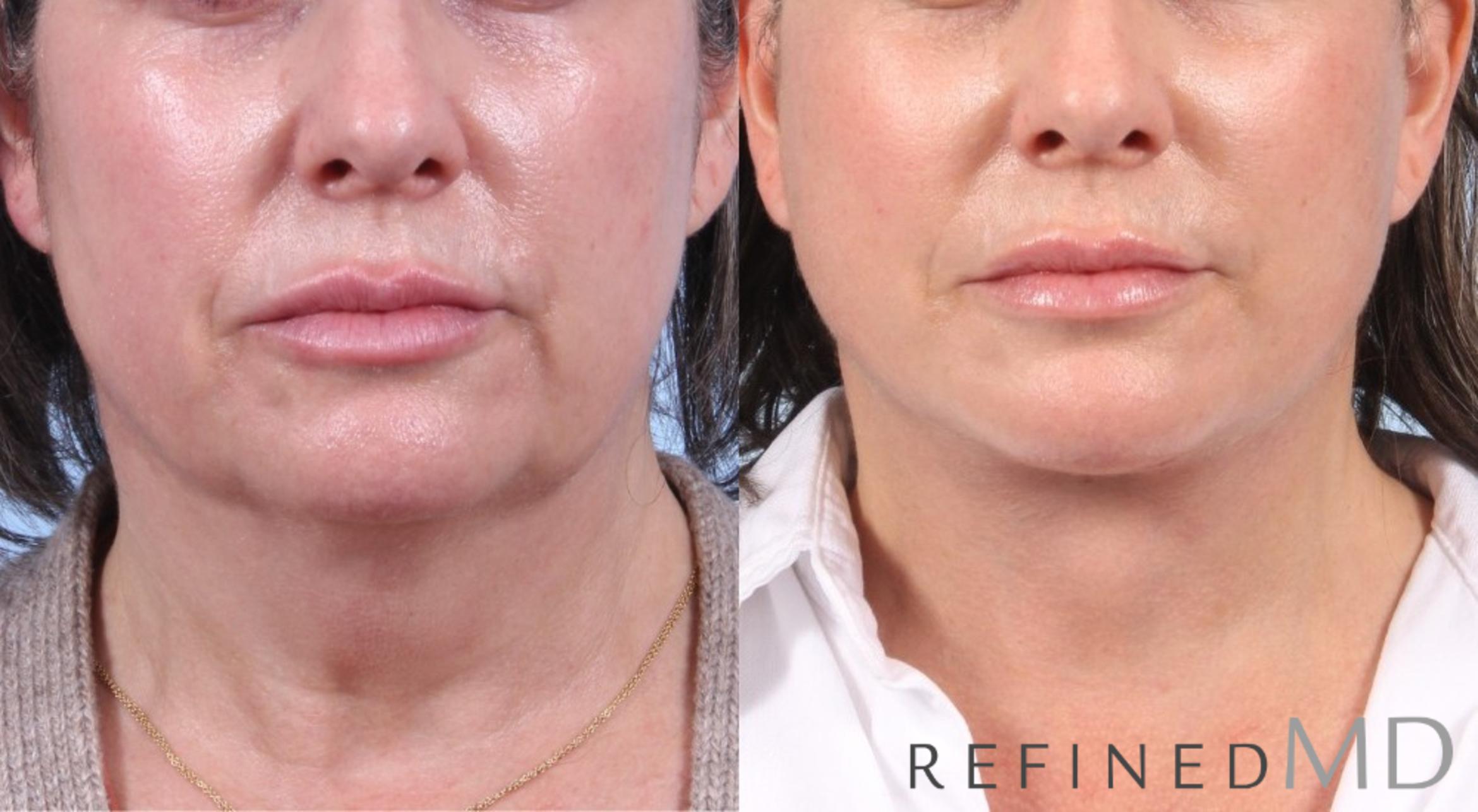 Before & After Facelift Case 1060 View 1 View in Los Gatos & San Jose, CA