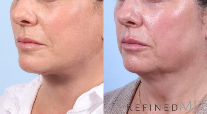 Before & After Facelift Case 1060 View 2 View in Los Gatos & San Jose, CA