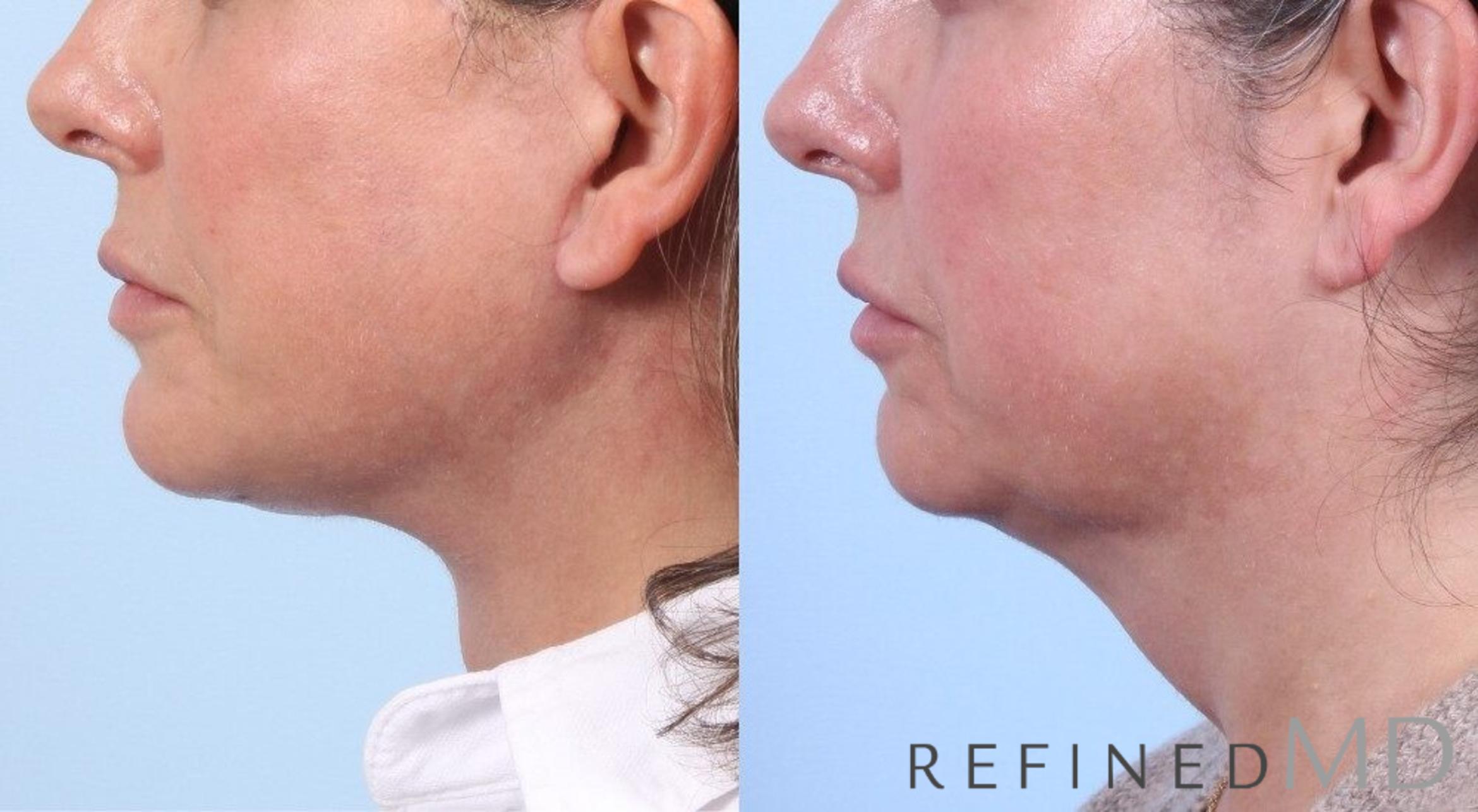 Before & After Facelift Case 1060 View 3 View in Los Gatos & San Jose, CA