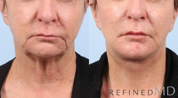 Before & After Facelift Case 1061 View 1 View in Los Gatos & San Jose, CA