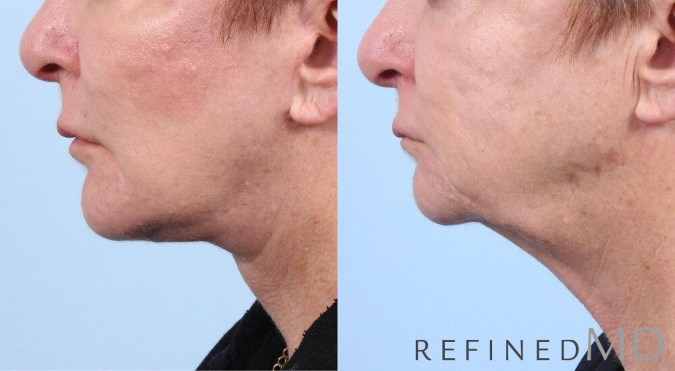 Before & After Facelift Case 1061 View 2 View in Los Gatos & San Jose, CA