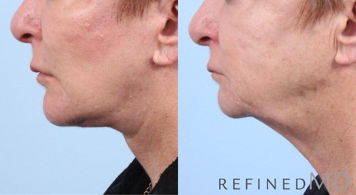 Before & After Facelift Case 1061 View 2 View in Los Gatos & San Jose, CA