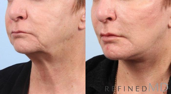 Before & After Facelift Case 1061 View 3 View in Los Gatos & San Jose, CA