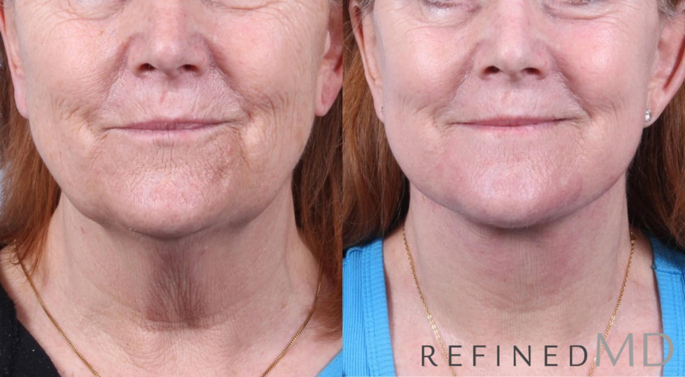 Before & After Facelift Case 1062 View 1 View in Los Gatos & San Jose, CA