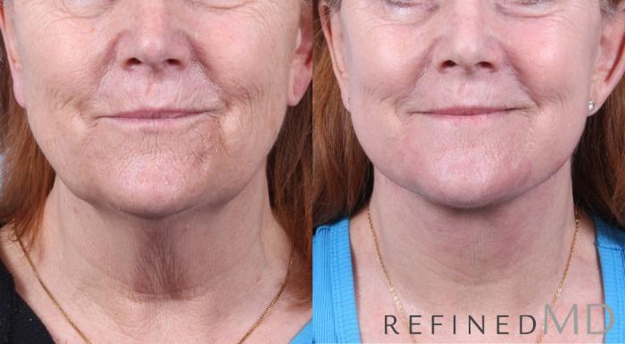 Before & After Facelift Case 1062 View 1 View in Los Gatos & San Jose, CA