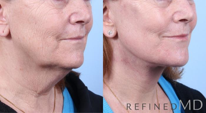 Before & After Facelift Case 1062 View 2 View in Los Gatos & San Jose, CA