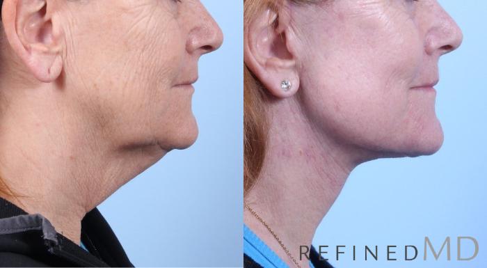 Before & After Facelift Case 1062 View 3 View in Los Gatos & San Jose, CA