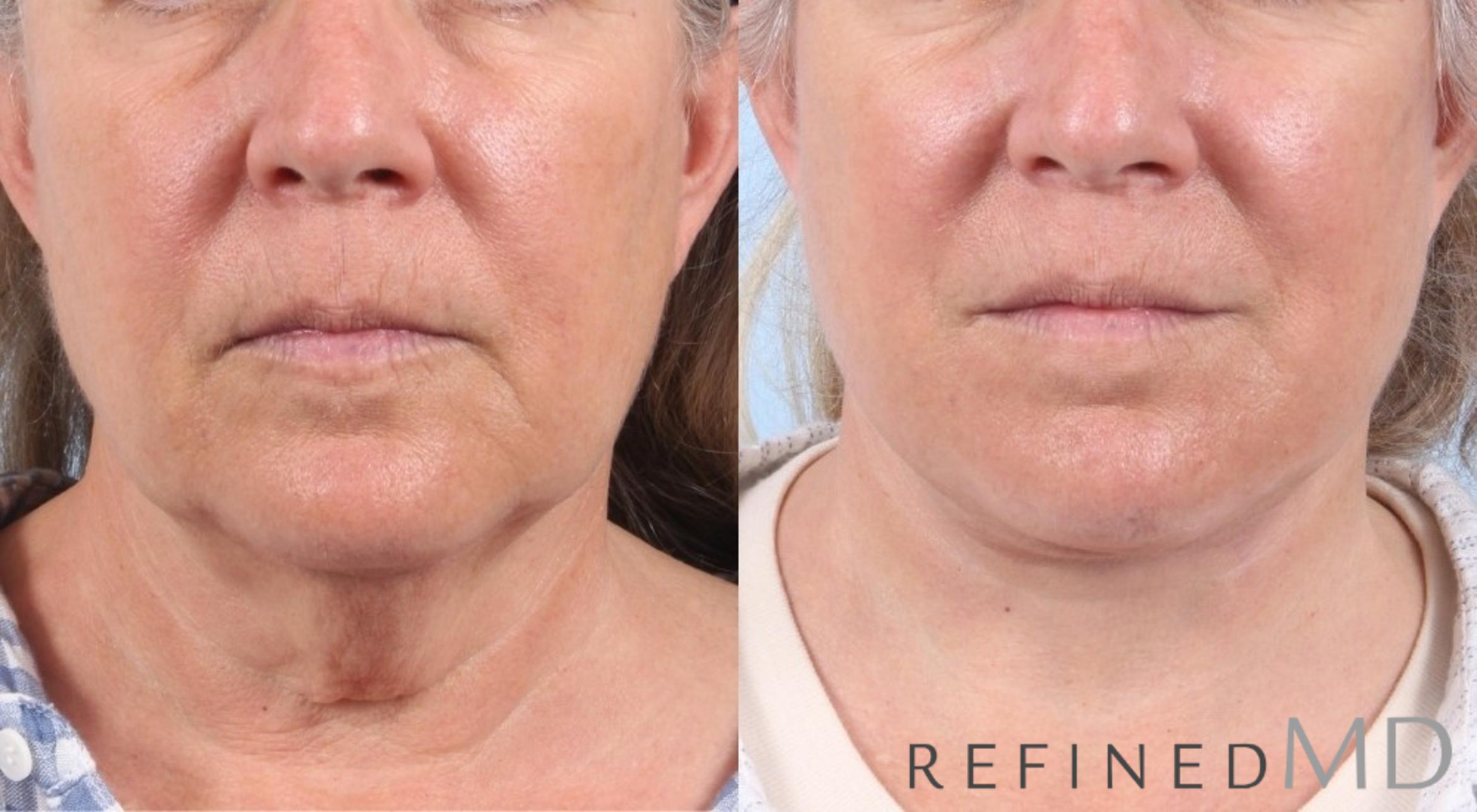 Before & After Facelift Case 1063 View 1 View in Los Gatos & San Jose, CA