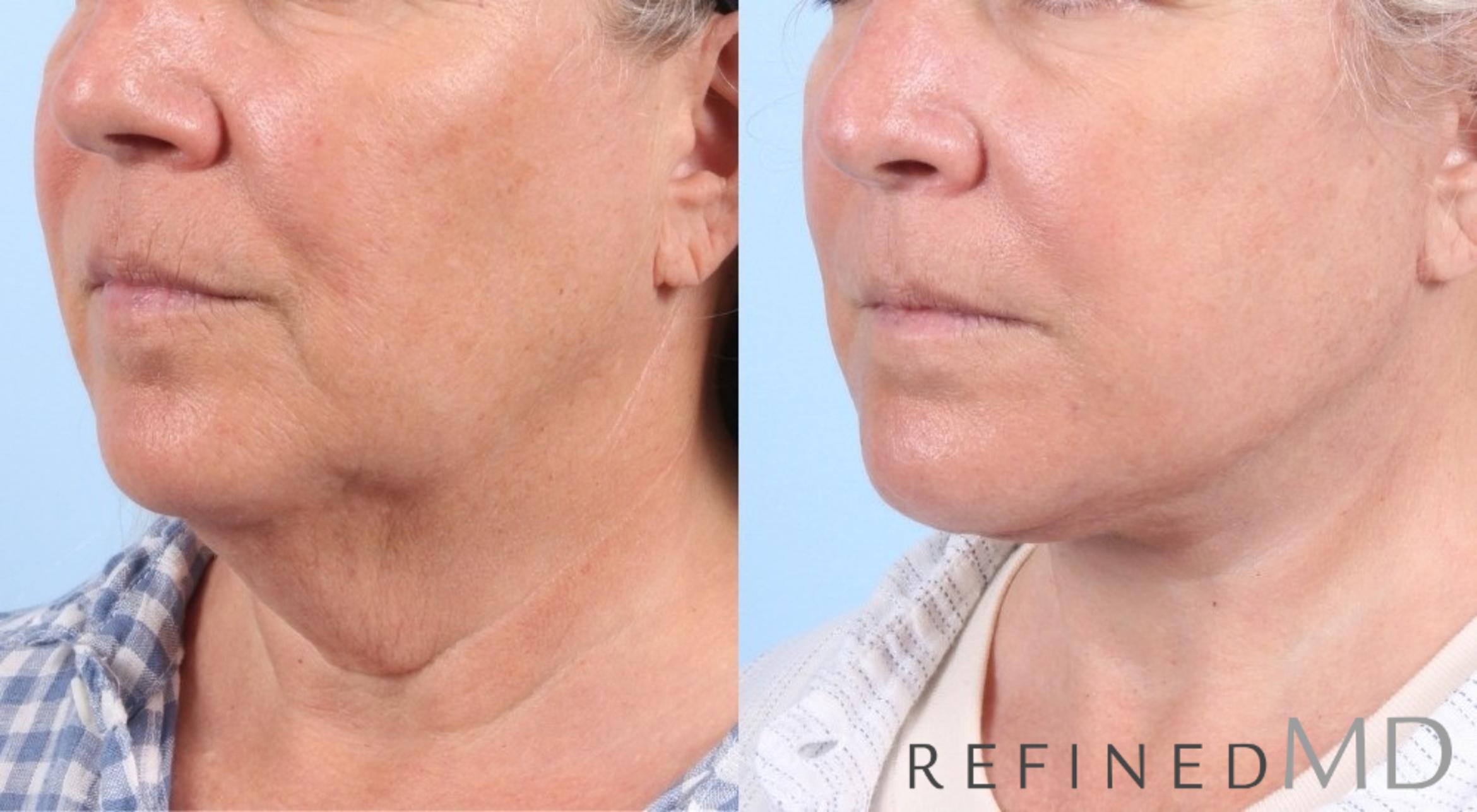 Before & After Facelift Case 1063 View 2 View in Los Gatos & San Jose, CA
