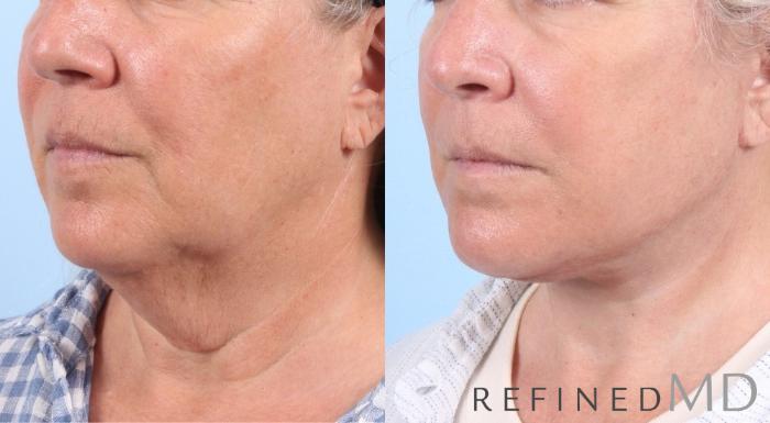 Before & After Facelift Case 1063 View 2 View in Los Gatos & San Jose, CA