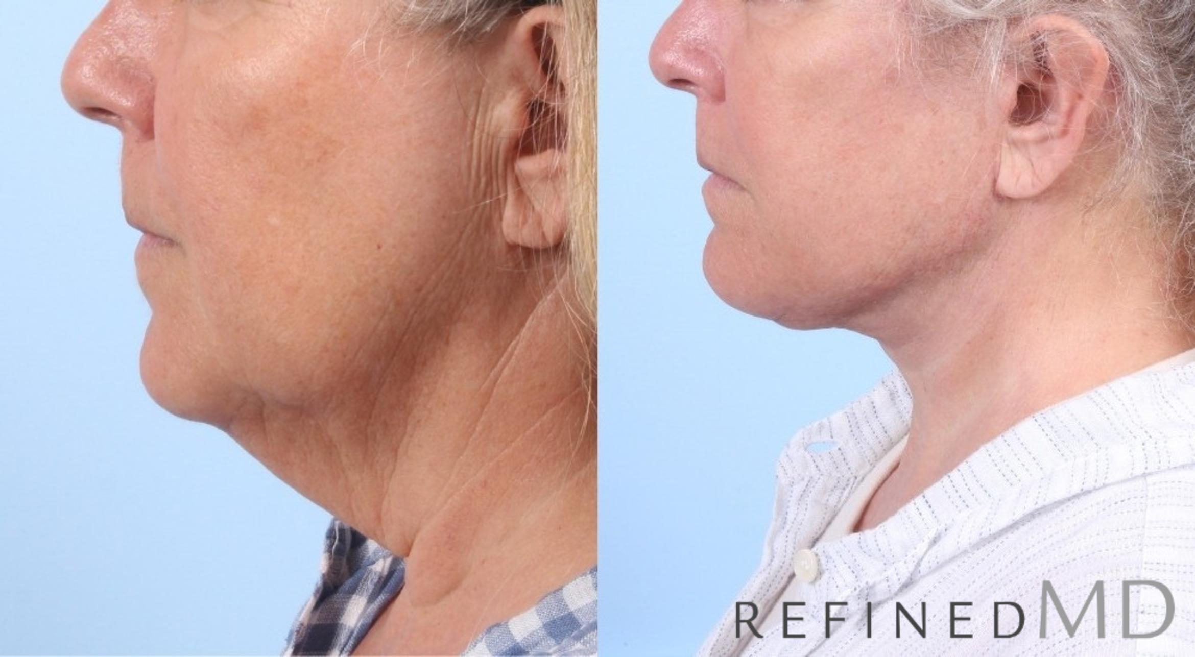 Before & After Facelift Case 1063 View 3 View in Los Gatos & San Jose, CA