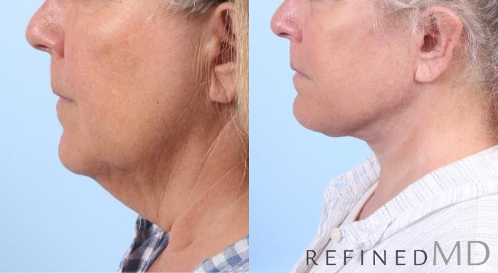 Before & After Facelift Case 1063 View 3 View in Los Gatos & San Jose, CA
