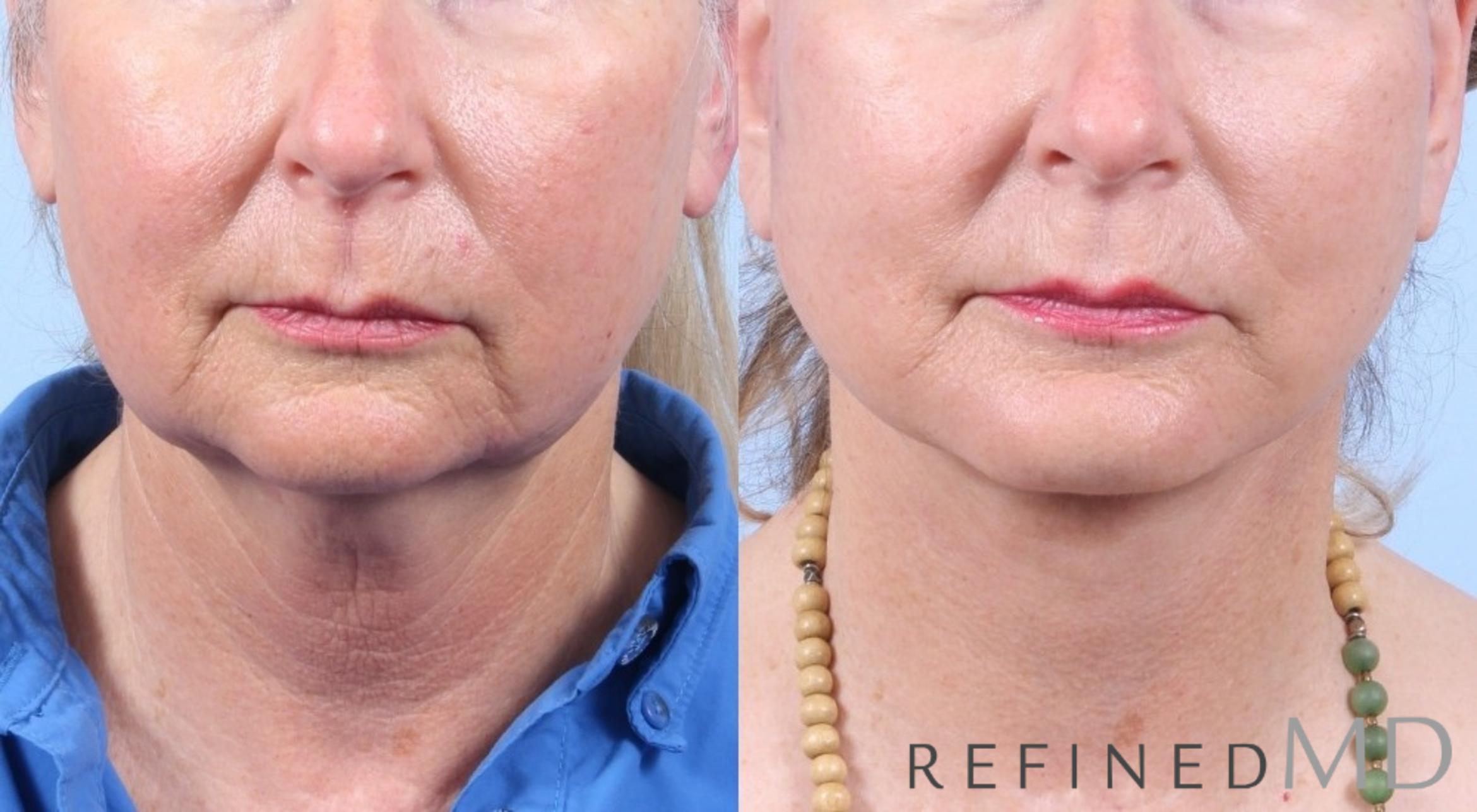 Before & After Facelift Case 1064 View 1 View in Los Gatos & San Jose, CA