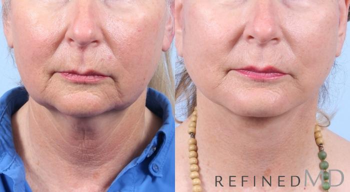 Before & After Facelift Case 1064 View 1 View in Los Gatos & San Jose, CA