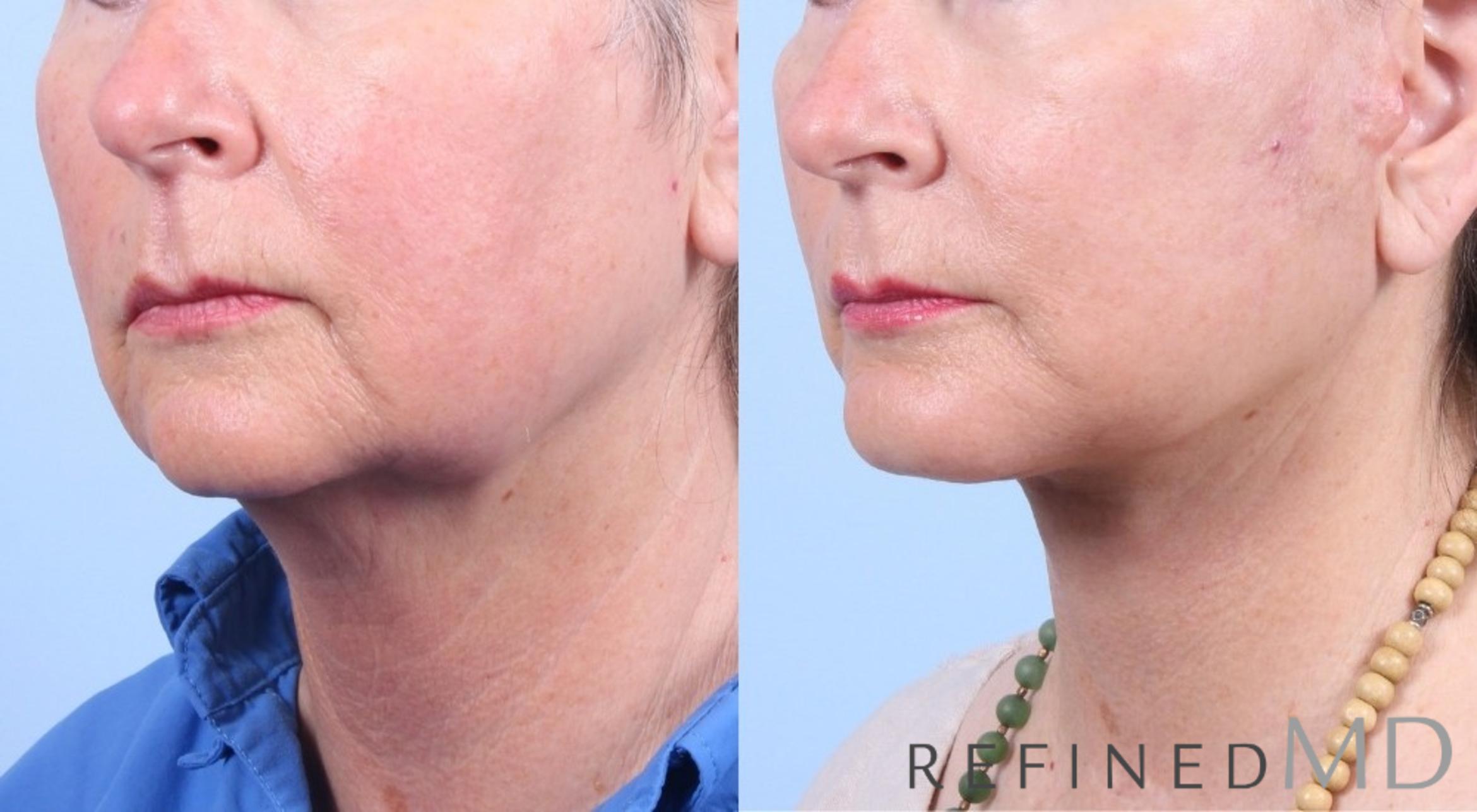 Before & After Facelift Case 1064 View 2 View in Los Gatos & San Jose, CA