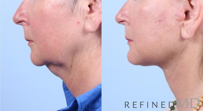 Before & After Facelift Case 1064 View 3 View in Los Gatos & San Jose, CA