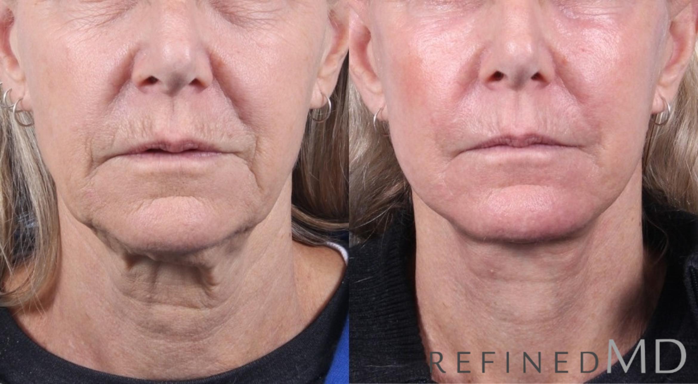 Before & After Facelift Case 1065 View 1 View in Los Gatos & San Jose, CA