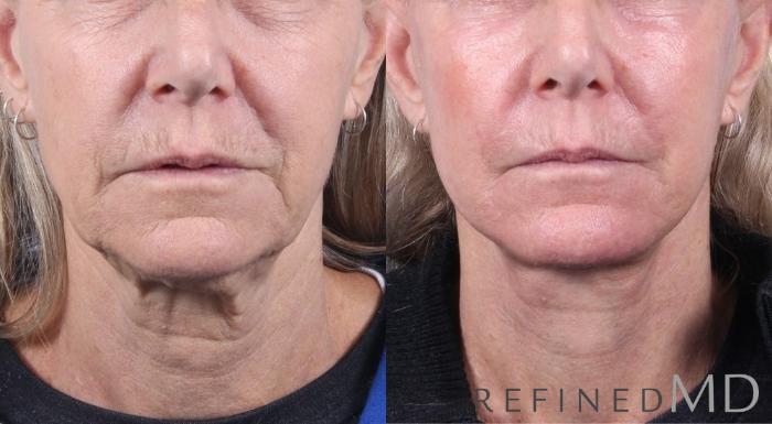 Before & After Facelift Case 1065 View 1 View in Los Gatos & San Jose, CA
