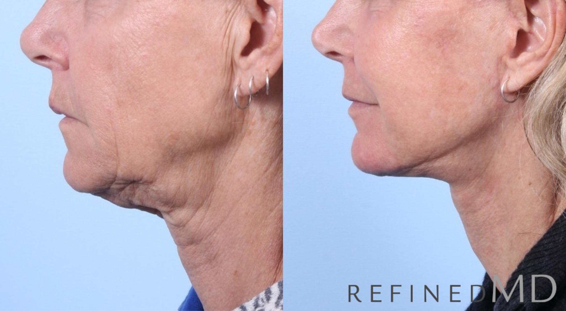 Before & After Facelift Case 1065 View 2 View in Los Gatos & San Jose, CA