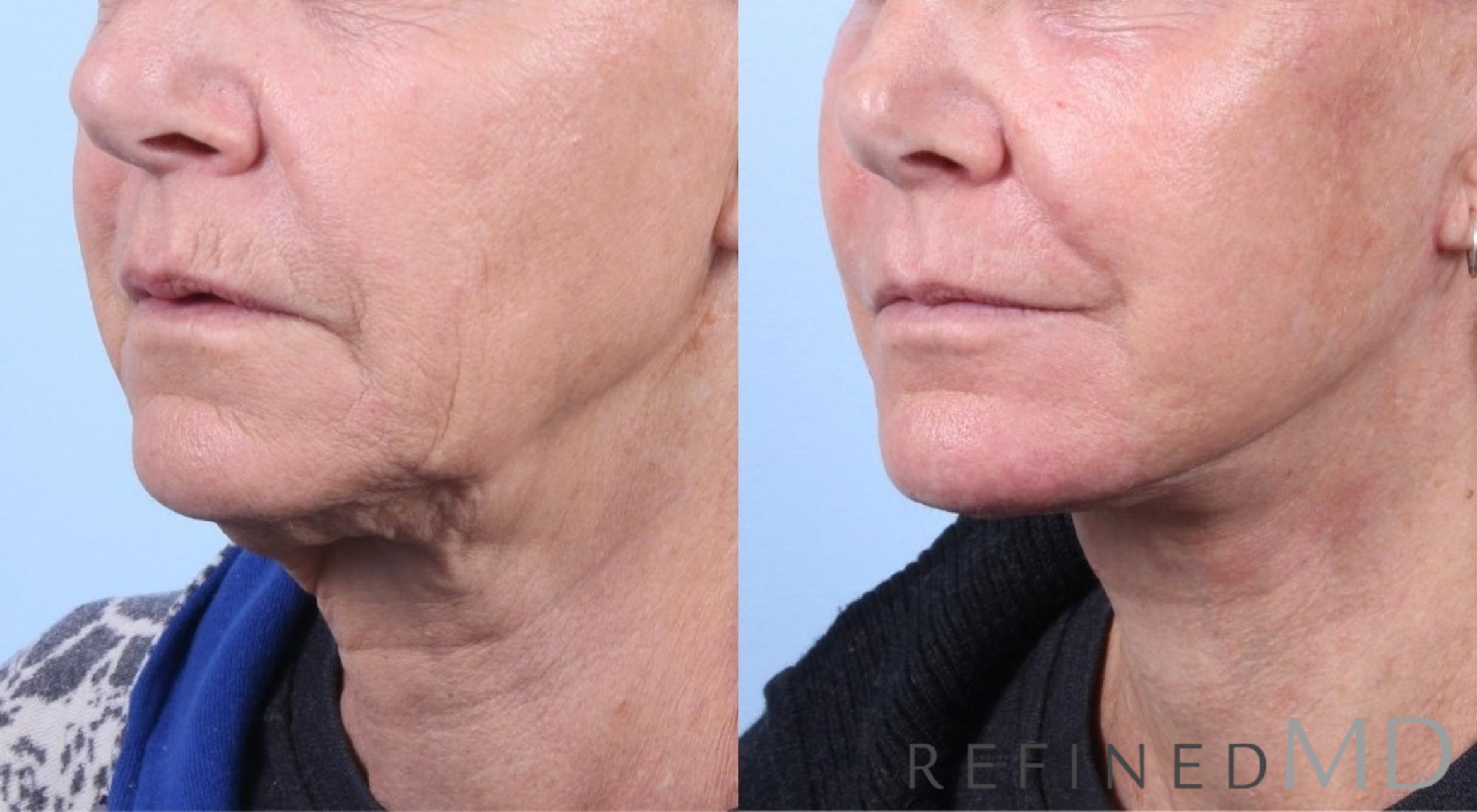 Before & After Facelift Case 1065 View 3 View in Los Gatos & San Jose, CA