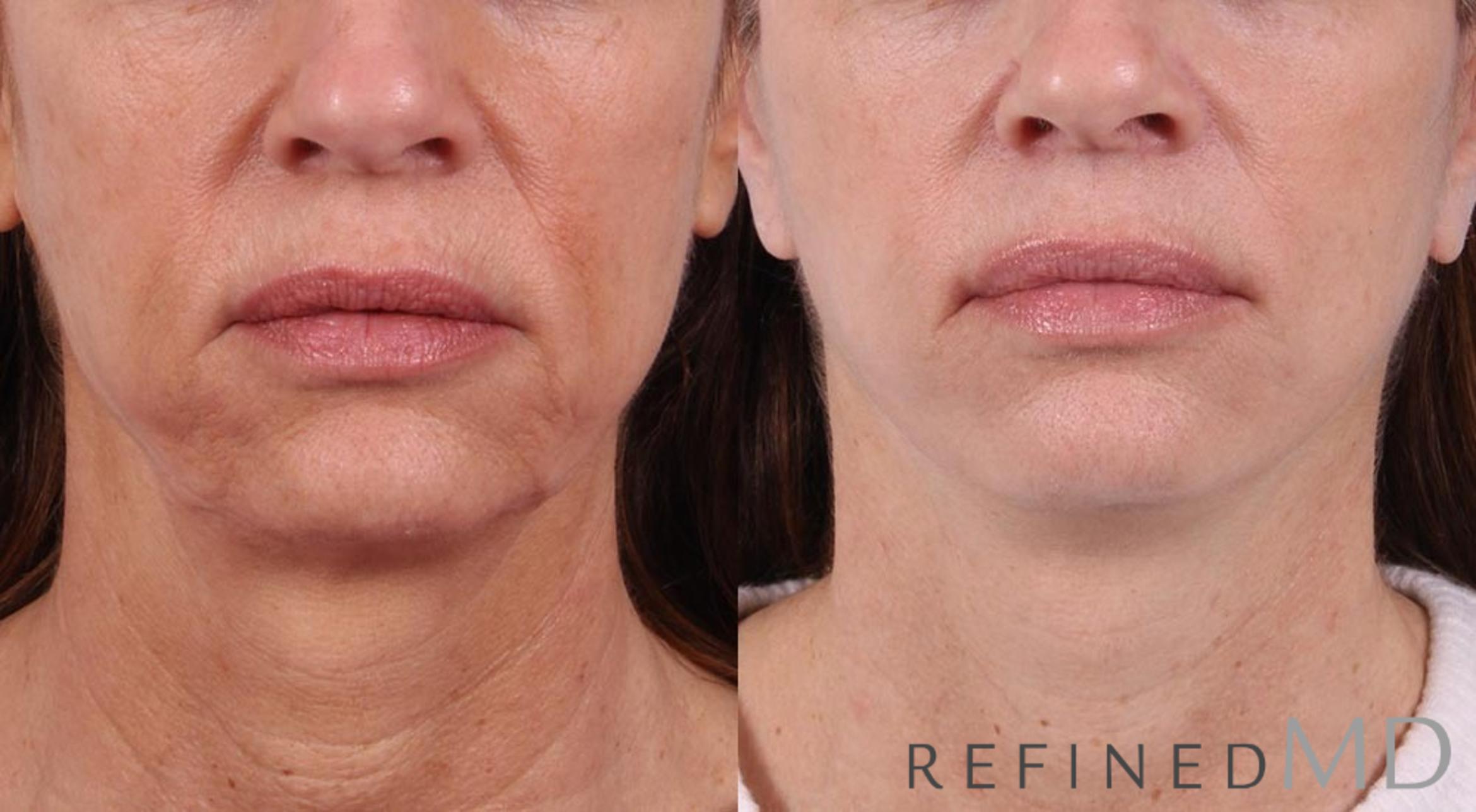 Before & After Facelift Case 1066 View 1 View in Los Gatos & San Jose, CA