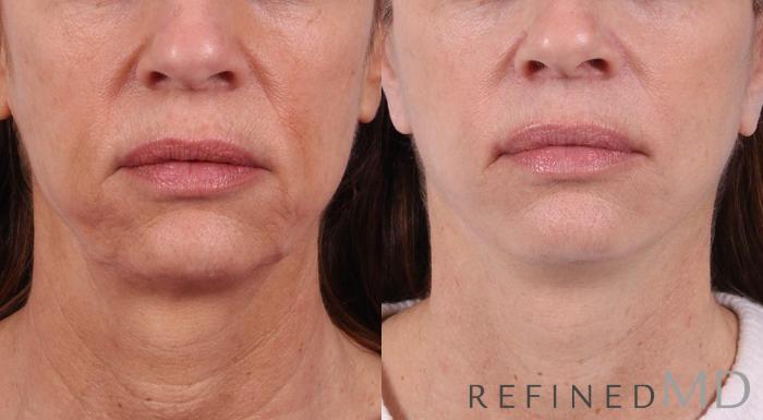 Before & After Facelift Case 1066 View 1 View in Los Gatos & San Jose, CA
