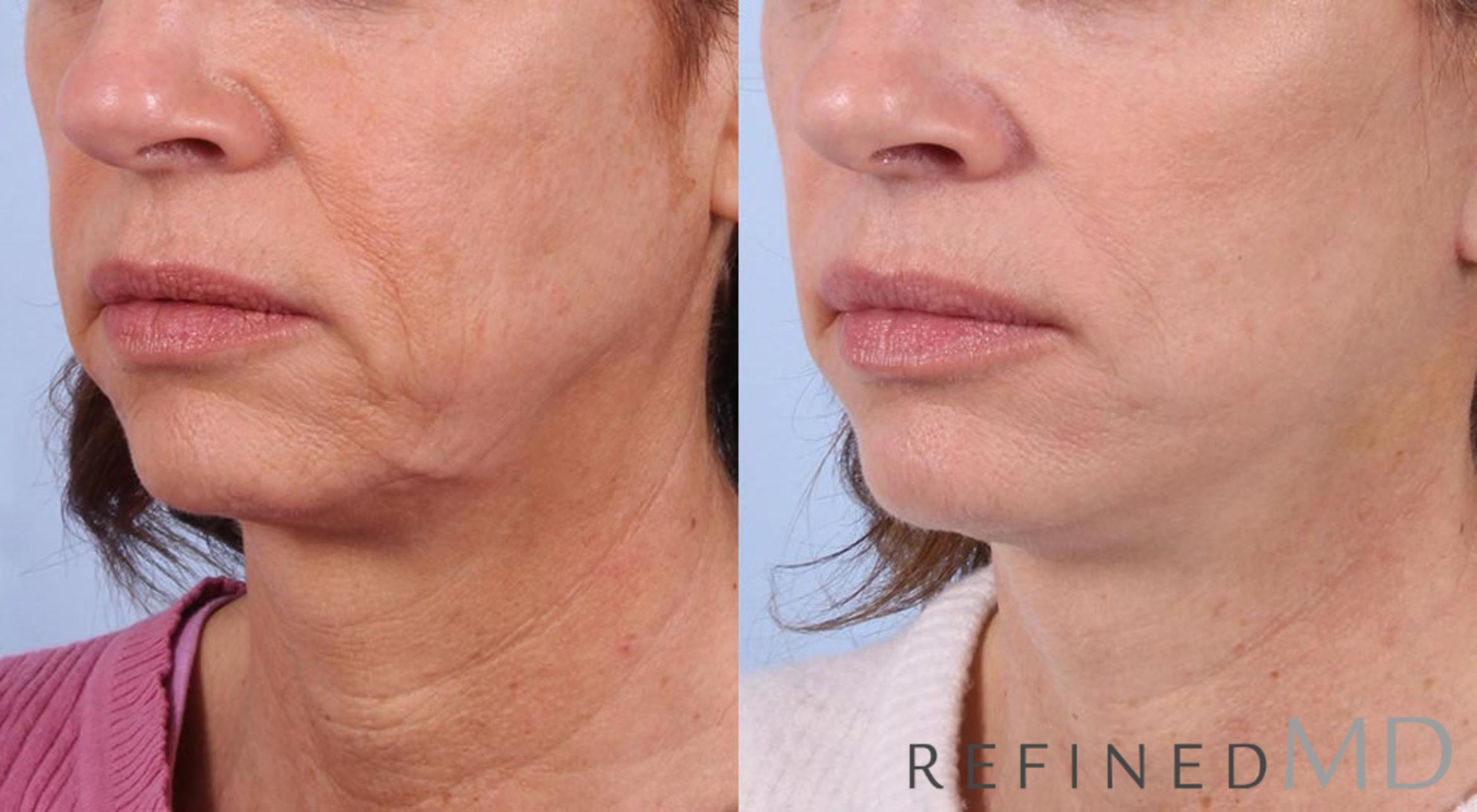 Before & After Facelift Case 1066 View 2 View in Los Gatos & San Jose, CA