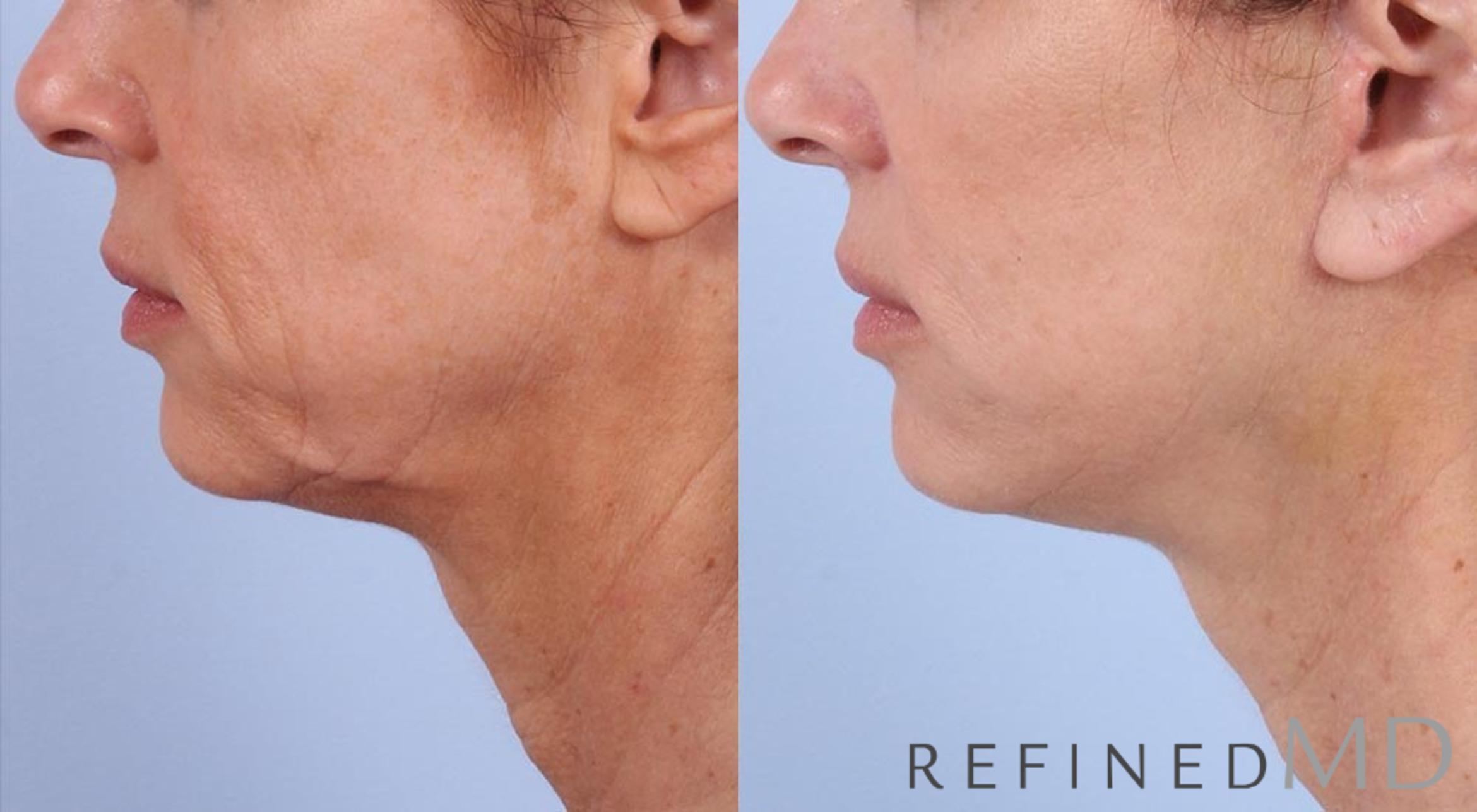 Before & After Facelift Case 1066 View 3 View in Los Gatos & San Jose, CA