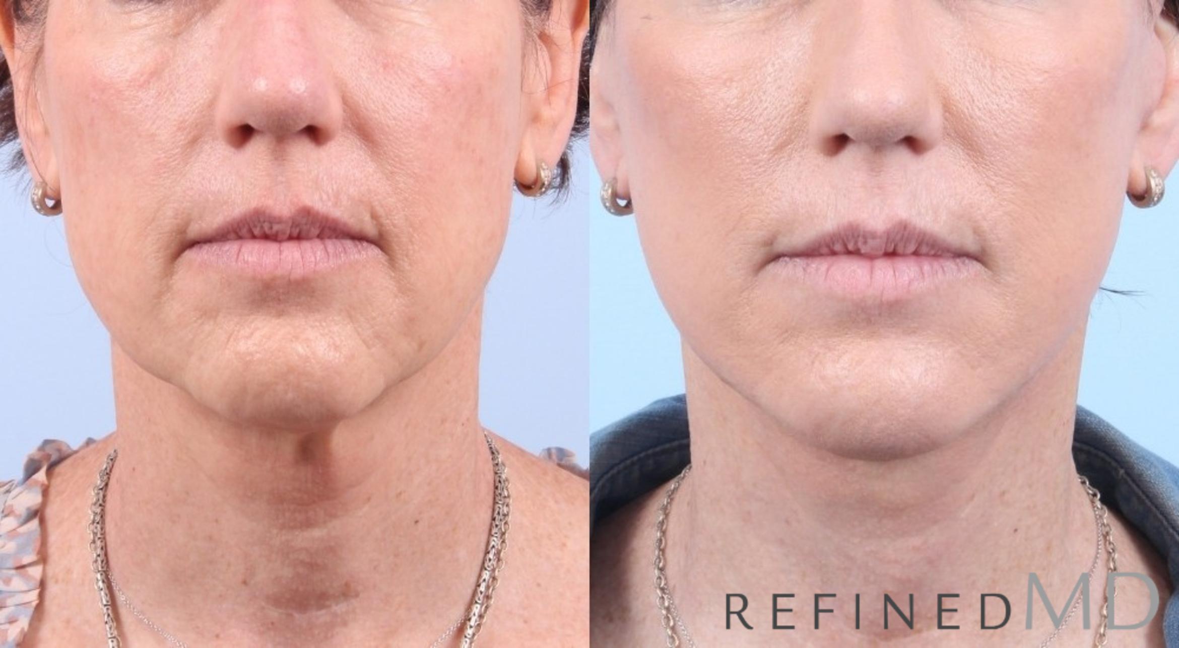 Before & After Facelift Case 1067 View 1 View in Los Gatos & San Jose, CA