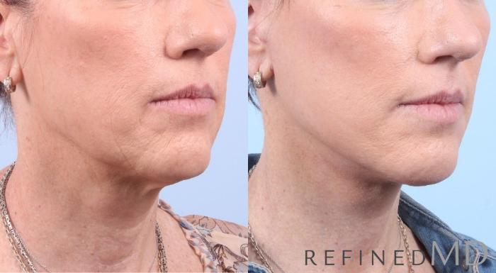 Before & After Facelift Case 1067 View 2 View in Los Gatos & San Jose, CA