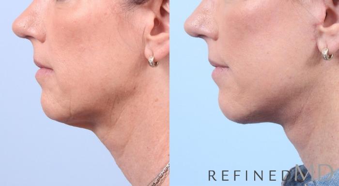 Before & After Facelift Case 1067 View 3 View in Los Gatos & San Jose, CA
